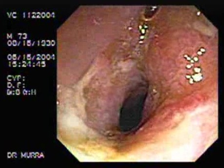 Choroba Leśniowskiego-Crohna zastawki krętniczo-kątniczej i końcowego odcinka jelita cienkiego (3 z 5)