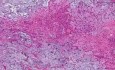 Gruczolak wielopostaciowy - histopatologia ślinianek