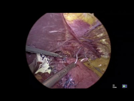 Geometry Fundoplication App - instruktaż, rozdział 09- przebieg fundoplikacji 360°