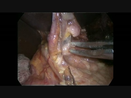 Minimalnie inwazyjne esophagektomia metodą Ivora Lewisa