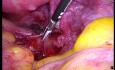 Endometrioza głęboko naciekająca