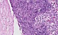 Rak płaskonabłonkowy - histopatologia - przełyk
