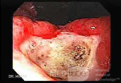 Wrzody u pacjenta z marskością wątroby - widok w inwersji endoskopowej