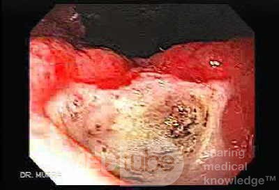 Wrzody u pacjenta z marskością wątroby - widok w inwersji endoskopowej