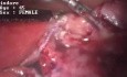 Salpingektomia laparoskopowa - ropniak jajowodu