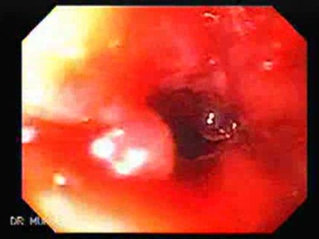 Perforacja przełyku w wyniku hydrostatycznego poszerzania balonem - bliższe spojrzenie na na guza