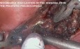 Transvesical Simple Prostatectomy and Diverticulectomy with Single-Port Robot