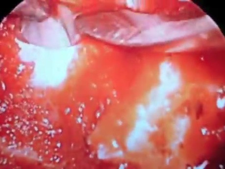 Endoskopowa operacja przysadki - lewa torbiel Rathkego w okolicy siodła