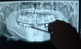 Pantomogram złamania żuchwy