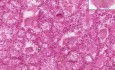 Choroba Gravesa-Basedowa - histopatologia tarczycy