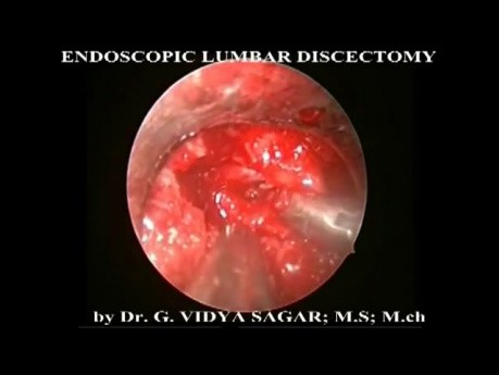 Endoskopowa discektomia lędźwiowa