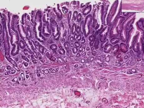 Zanikowe zapalenie błony śluzowej żołądka - histopatologia