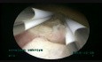 Usunięcie mięśniaka (4,5cm) za pomocą bipolarnego resektoskopu