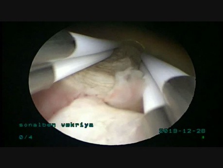 Usunięcie mięśniaka (4,5cm) za pomocą bipolarnego resektoskopu