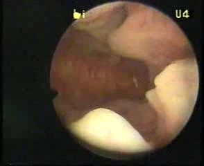 Obraz histeroskopowy przerostu endometrium