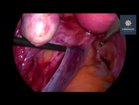 Preparowanie przestrzeni Okabayashi podczas laparoskopowej operacji endometriozy