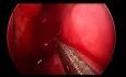 Przewlekłe zapalenie zatok przynosowych z polipami - full house FESS (endoskopowa operacja zatok przynosowych)
