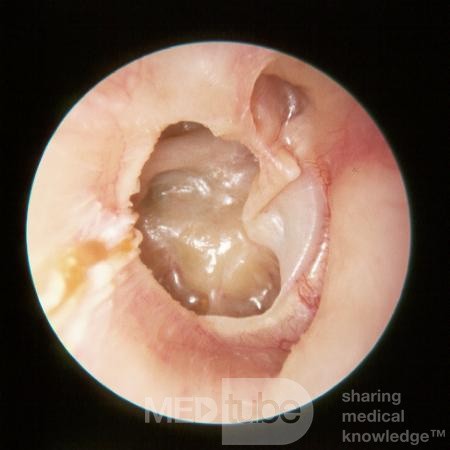 Ciężkie wysiękowe zapalenie ucha środkowego