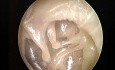Zrosty w jamie bębenkowej po zapaleniu ucha środkowego - otoendoskopia 30º
