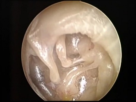 Zrosty w jamie bębenkowej po zapaleniu ucha środkowego - otoendoskopia 30º