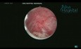 Histeroskopowa miomektomia włókniaków typu 1 i 2 wg FIGO