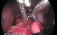 Door - operacja przepukliny okołoprzełykowej