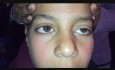 Abordaje Orbital de Singh para cirugía de ptosis. Resultados en ptosis moderada