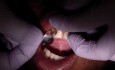 Metalowa Kształtka  do odbudowy Kompozytem zęba przedniego