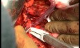 Aplikacja matrycy TachoSil podczas całkowitej resekcji żołądka z usunięciem węzłów chłonnych w zakresie D2
