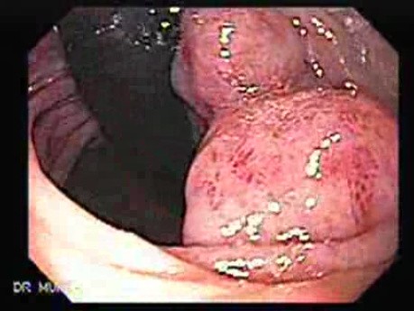 Chłoniak żołądka z przerzutami do dwunastnicy - ocena dwunastnicy w inwersji endoskopowej, część 1