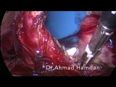 Całkowita laparoskopowa histerektomia z diatermią LigaSure