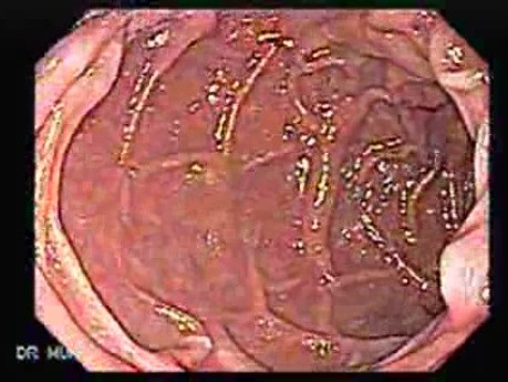 Chłoniak żołądka z przerzutami do dwunastnicy - obecność przerzutów zaopuszkowych