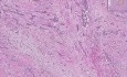Pęcherz moczowy - rak z komórek urotelialnych, Grade III
