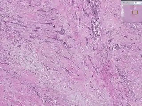 Pęcherz moczowy - rak z komórek urotelialnych, Grade III