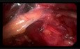 Minilaparoskopia w leczeniu przepukliny lędźwiowej