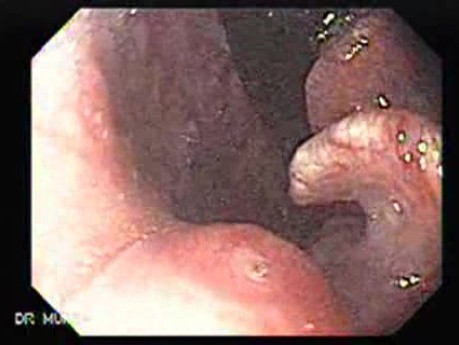 Uchyłek Zenkera - obraz nosogardła w inwersji endoskopowej