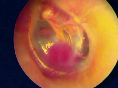 GLOMUS TIMPANICO