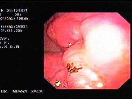 Dziedziczny rozlany rak żołądka (HDGC) - endoskopia (1 z 4)