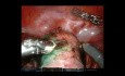 Rak endometrium - robotyczna całkowita laparoskopowa histerektomia i wycięcie węzła wartowniczego