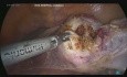 Całkowita laparoskopowa histerektomia w wypadku wypadania narządu rodnego i pektopeksji