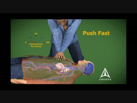 Resuscytacja krążeniowo-oddechowa - RKO - Animacja medyczna 3D