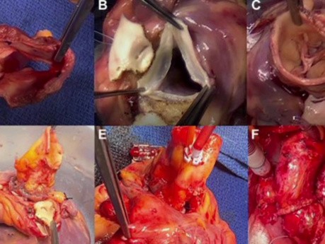 Transplantacja serca z wykorzystaniem serca dawcy i biorcy