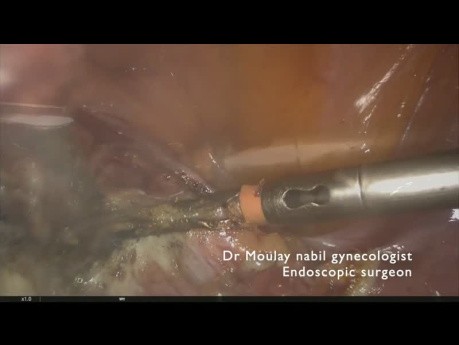 Całkowita laparoskopowa histerektomia z zachowaniem jajników