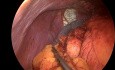 Laparoskopowa fundoplikacja Toupeta u pacjenta z całkowitym odwróceniem trzewi