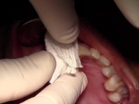 Ekstrakcja zęba #8 z prostym przeszczpem kostnym
