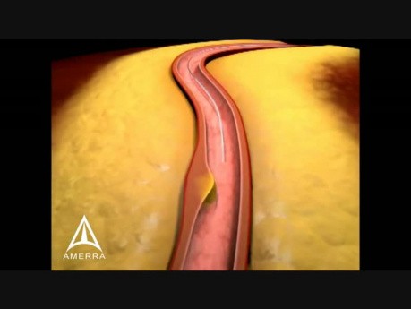 Zabieg stentowania tętnic - Medyczna Animacja 3D