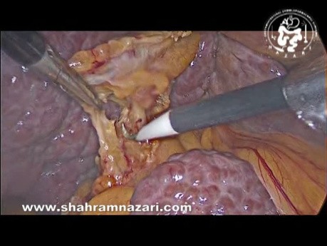 Cholecystektomia laparoskopowa u pacjenta z marskością wątroby