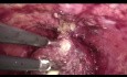 Prostatektomia radykalna laparoskopowa - krok po kroku