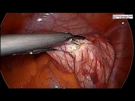 Laparsokopowa cystektomia jajnika- aspiracja z wykorzystaniem igły transparentnej