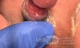 Post Circumcision Platibell Paraphemosis- Post Removal of Platibell